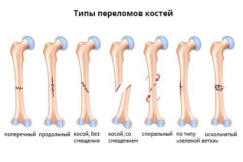 Клиника переломов