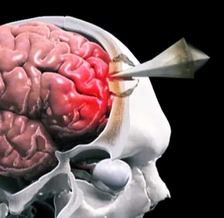 Нарушение сознания: механизм появления