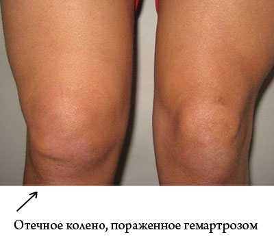 Осложнения