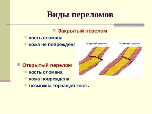 Типы переломов